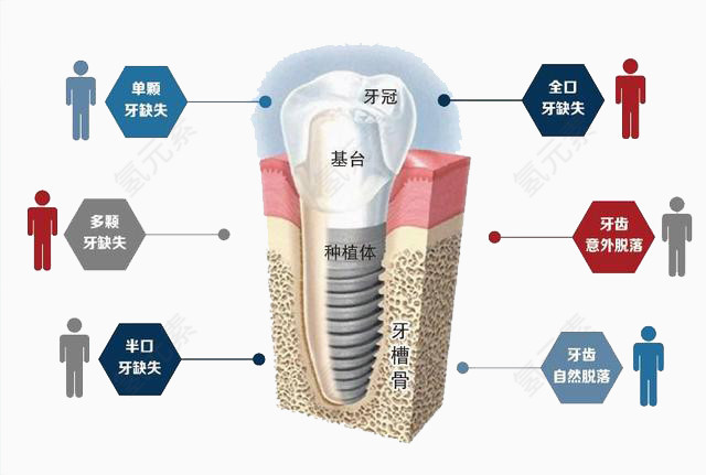 牙齿分解图