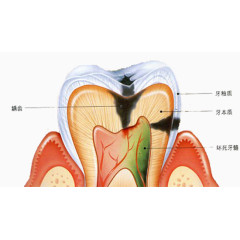 蛀牙原理