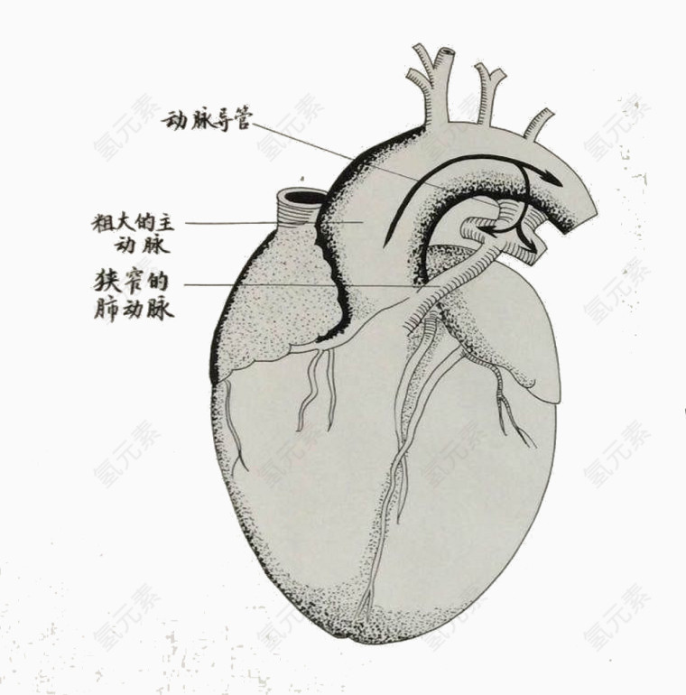 动脉狭窄