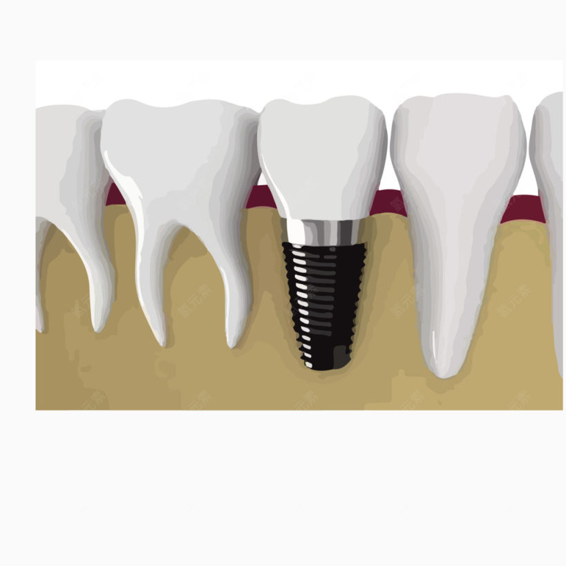 口腔种植牙下载
