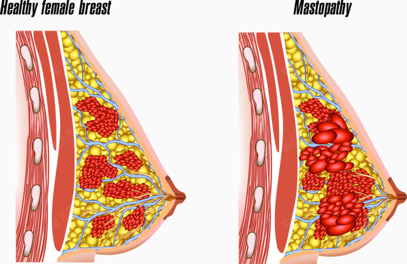 健康女性乳房和有疾病的乳房变化图下载