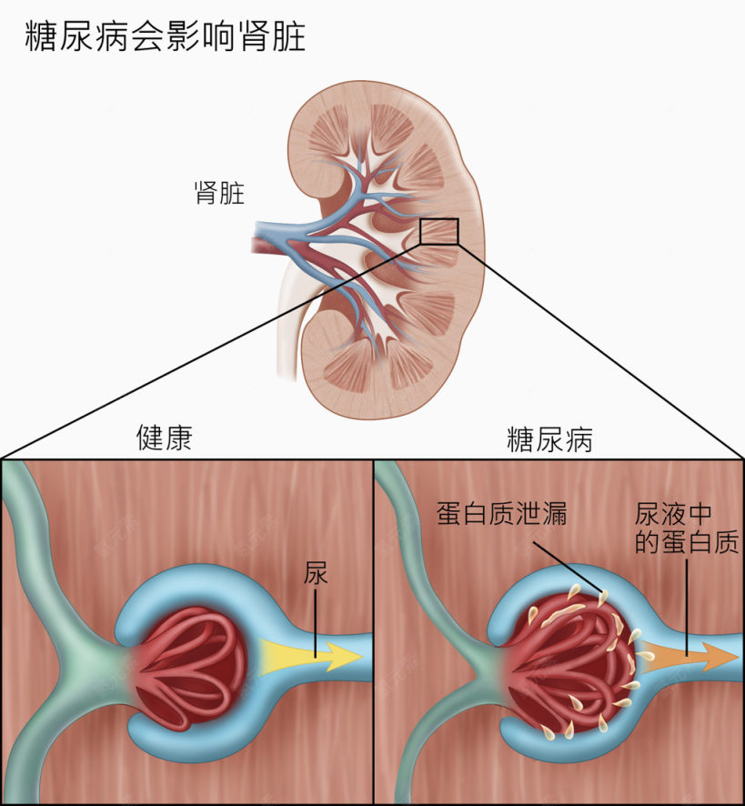 糖尿病会影响肾脏下载