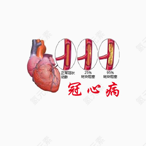 冠心病症状