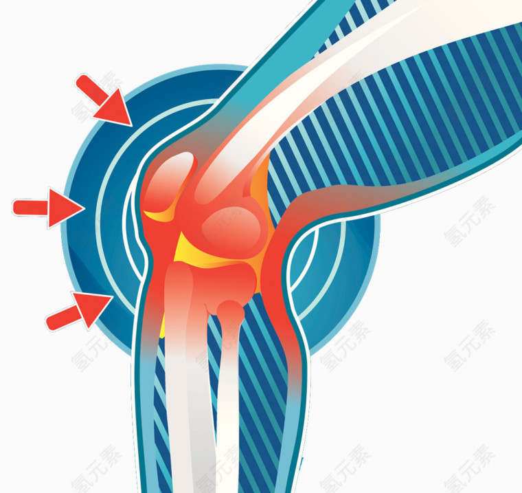膝关节发炎插图