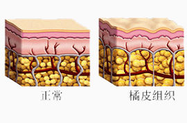 橘皮组织