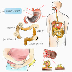 胃部病变医疗插画
