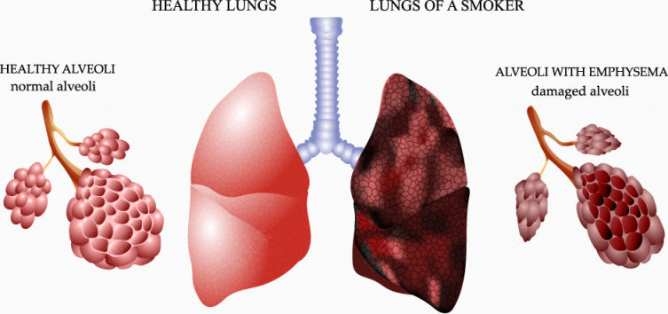 健康肺和香烟污染的肺对比图下载