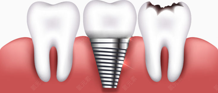 矢量补牙下载